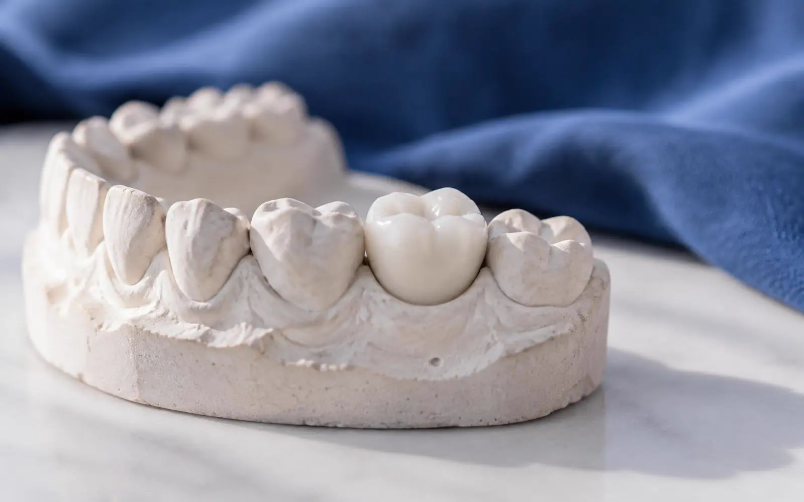 Een witte zirkonium kroon op een gipsen model van een tandenrij